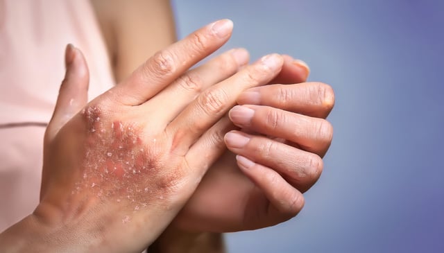 Two hands touch each other with visible dry, flaky skin and redness on one hand. The fingers appear slightly curled, highlighting the rough texture of the affected area.